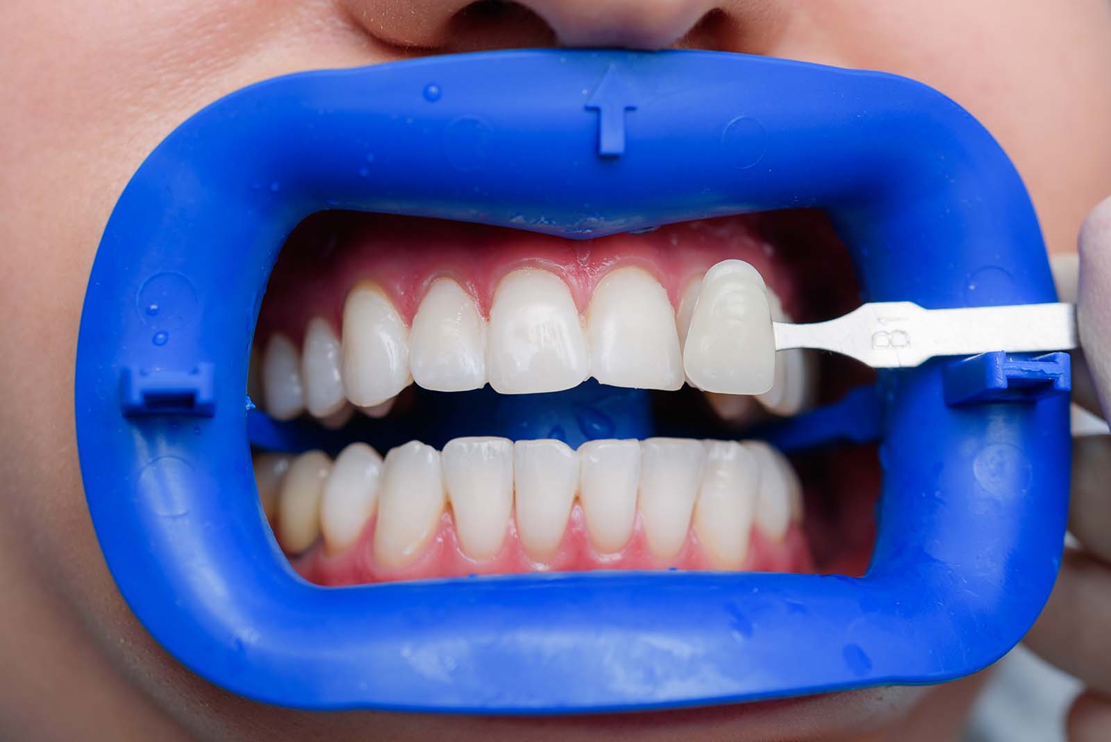 Teeth whitening application at Dearborn Family Dentistry